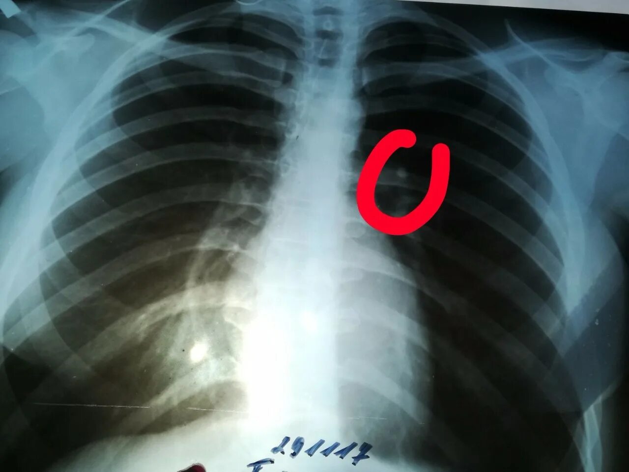 Плотный заметить. Рентген грудной клетки перелом ребер. Поднадкостничный перелом ребра. Перелом 8 ребра справа рентген. Рентген перелом ребра слева.