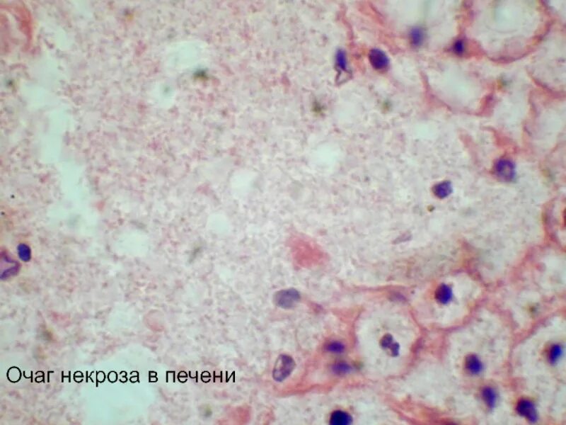 Некроз - это гибель клеток, тканей или целых