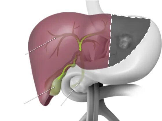 Печень после операции. Лапароскопическая гемигепатэктомия. Резекция печени топографическая анатомия. Неанатомические резекции печени.