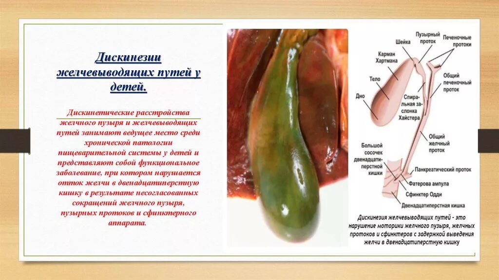 Желчно выводящие пути. Клиническая картина дискинезии желчевыводящих путей. Памятка дискинезия желчевыводящих путей. Дискинезия жёлчного пузыря и желчевыводящих путей. Дискинезия желчного пузыря и желчных путей..