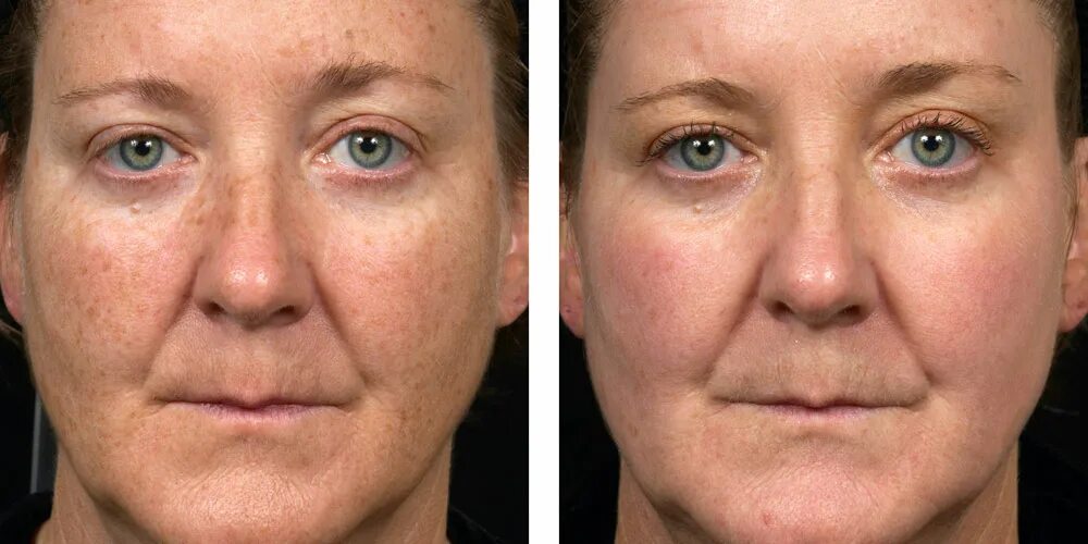 Лазерное воздействие на кожу skinlift ru. Фракционный фототермолиз со2. Лазерный пилинг фраксель. Фракционный фототермолиз со2 реабилитация.