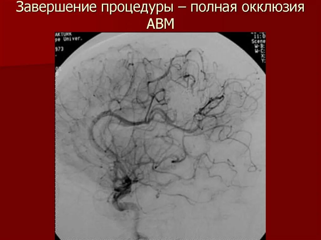 Сосудистая аномалия. Артериовенозная мальформация (АВМ). Мальформация сосудов шеи. Артерия венозная мальформация. Артерио венозная мальформация.