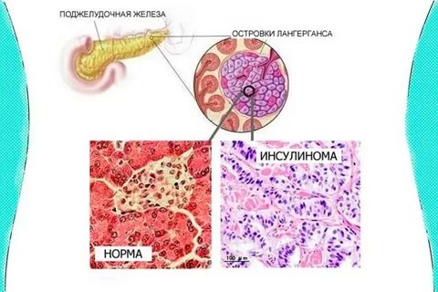 Инсулинома что это такое
