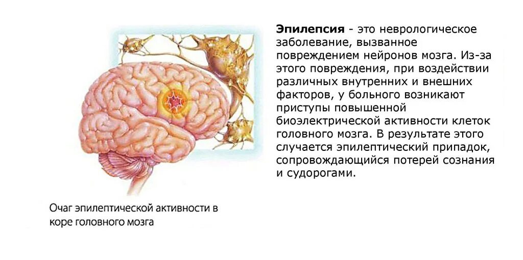 Эпилепсия нервной системы. Заболевание эпилепсия. Эпилепсия симптомы в неврологии. Эпилепсия головной мозг.