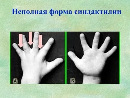 Аномалии пальцев