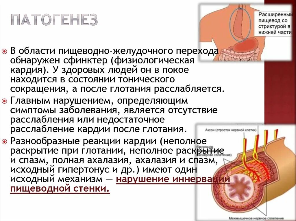 Короткий пищевод. Ахалазия кардии это спазм. Эзофагоспазм патогенез. Этиология ахалазии пищевода. Ахалазия кардии этиология патогенез.