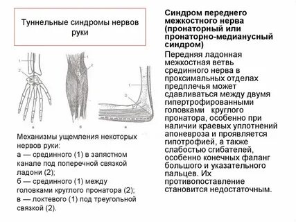 Защемление лучевого нерва