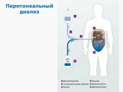 Диализ брюшной полости