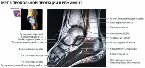 Трабекулярный отек лечение