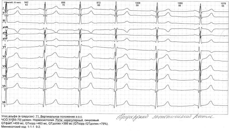 Нижнепредсердный ритм ЧСС. Эктопический нижнепредсердный ритм на ЭКГ. Левопредсердный ритм на ЭКГ. Верхнепредсердный ритм на ЭКГ. Эктопический предсердный ритм что это