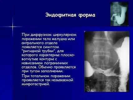 Эндофитная опухоль