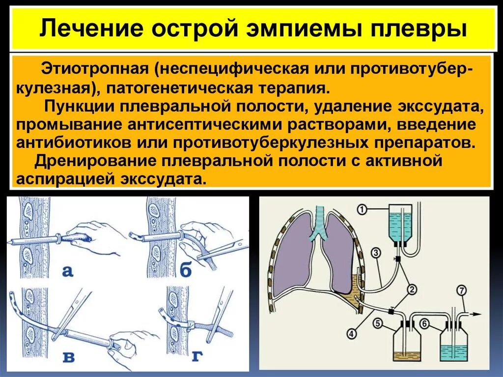 Пункция плевральной полости. Дренирование плевральной полости. Дренирование при эмпиеме плевры. Троакарный дренаж плевральной полости. Дренирование плевральной полости ребра.