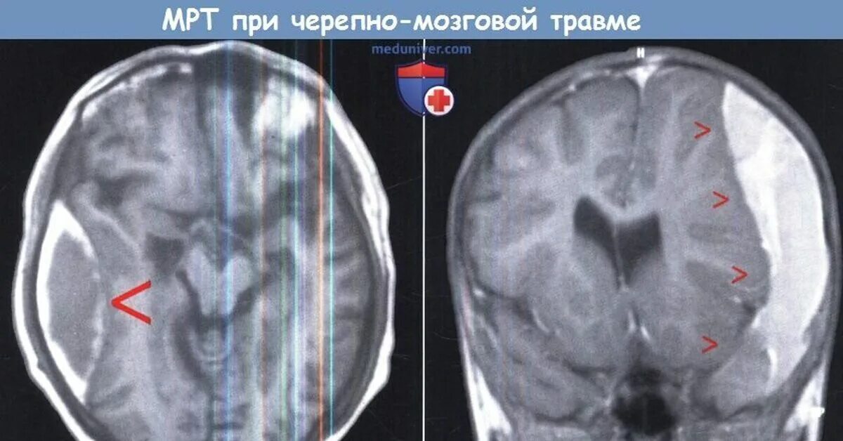 Мрт при сотрясении. Субдуральная гематома рентген. Черепно мозговая травма мрт. Черепно мозговая травма кт и мрт. Мрт при черепно-мозговой травме.