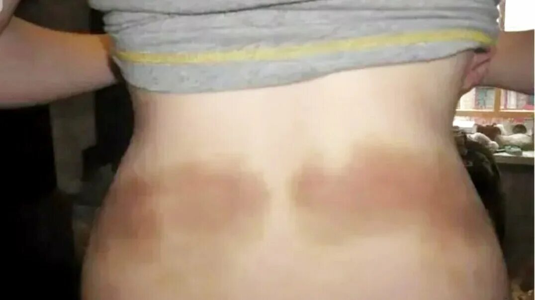 Озонотерапия растяжки. Что делать если образовались после. Первая помощь при ушибах. Заживление раны под струпом. Заживление ран под струпом.