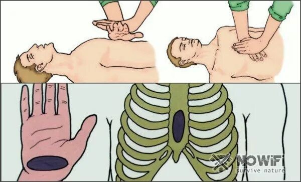 проведение непрямого массажа сердца. техника проведения непрямого массажа сердца. техника проведения непрямого массажа сердца. наружный закрытый непрямой массаж сердца. при закрытом массаже сердца надавливая на грудную клетку проводится.