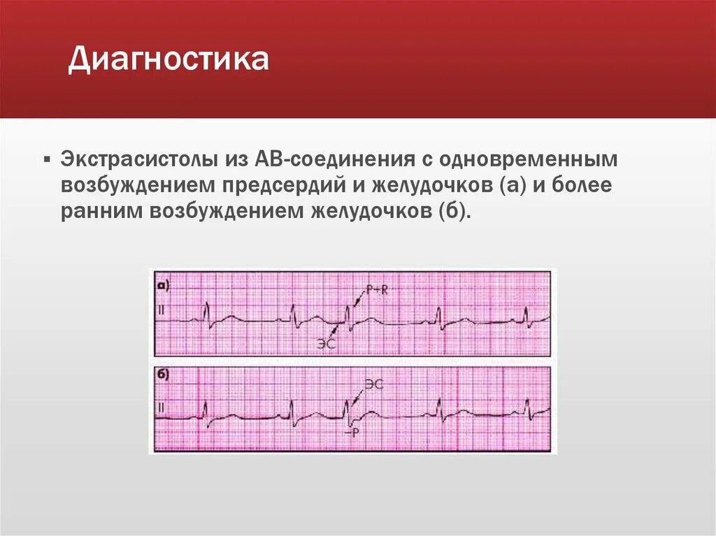 Аберрантные экстрасистолы на ЭКГ. АВ Узловая экстрасистолия на ЭКГ. Ранняя желудочковая экстрасистолия на ЭКГ. Атриовентрикулярная экстрасистолия на ЭКГ. 10 экстрасистола