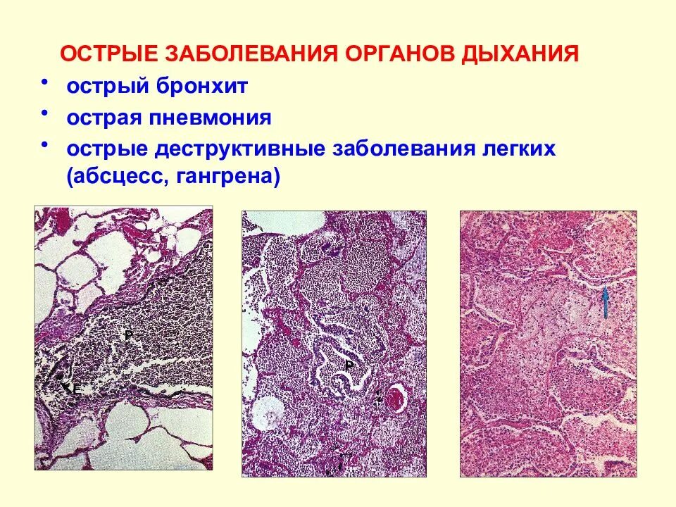 Заболеваемость острым бронхитом. Острое воспаление органов. Острые деструктивные процессы в легких. Пневмония (острая или обострение хронической). Острая инфекция легких