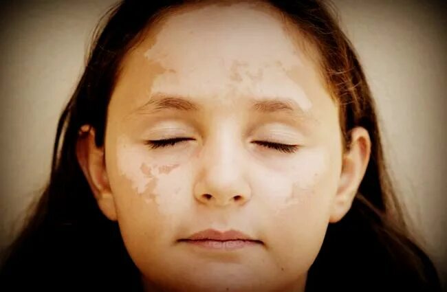 Идиопатический гипомеланоз. Белеет кожа. Отрубевидный лишай девержи. Руксолитиниб витилиго. Побелела кожа на пальцах рук.