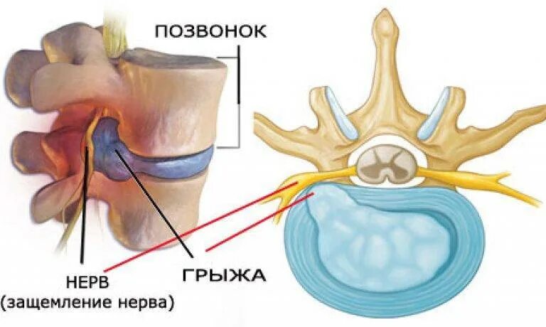 Грыжи и протрузии позвоночника. Протрузия и грыжа межпозвонковых дисков поясничного отдела. Грыжа поясничного отдела протрузия диска. Грыжа позвоночника экструзия.