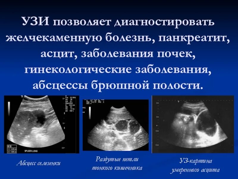Какие заболевания может показать узи брюшной полости. Асцит на узи брюшной полости. абсцесс брюшной полости на узи. узи брюшной полости при асците. жидкость в брюшной полости на узи.