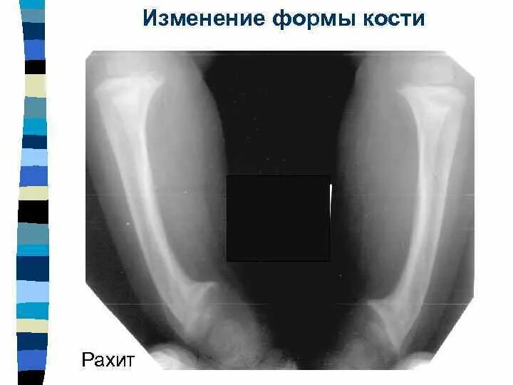 Изменение формы костей. Общая рентгеносемиотика изменения костной ткани. Изменение формы кости