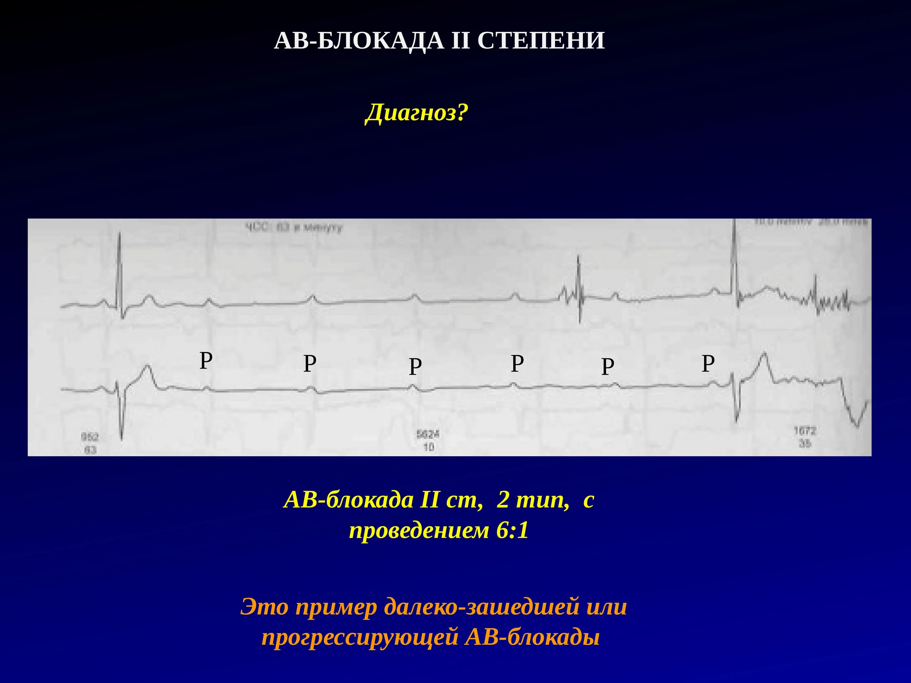 Блокада инструкция. Av блокада 2 степени с проведением 2:1. Диагноз АВ блокада 2 степени. АВ блокада диагноз. Далеко зашедшая АВ блокада.