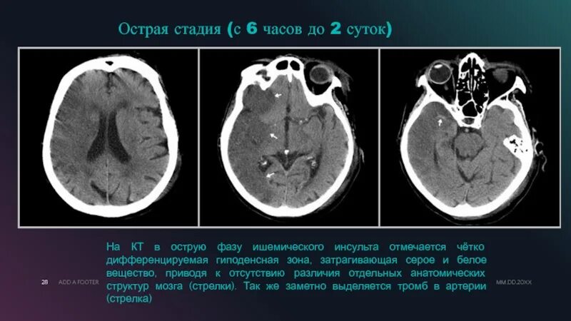 Ишемический инсульт мозга на кт. Ишемический инсульт снимок кт. Ишемический инсульт на кт головного мозга. Стадии ишемического инсульта на кт. Ишемические изменения головного мозга