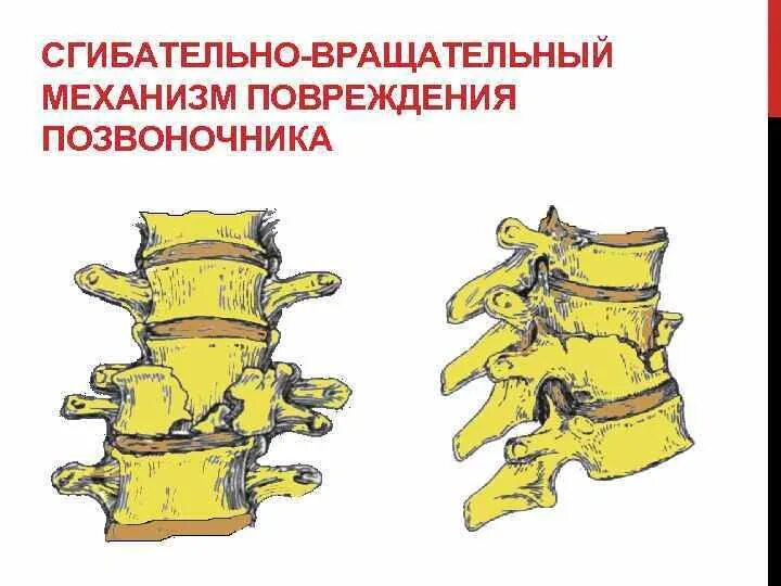 Сгибательный вращательный механизм повреждения позвоночника. Механизм травмы перелом позвоночника. Сгибательный механизм перелома позвоночника. Сгибательный механизм травмы позвонков.