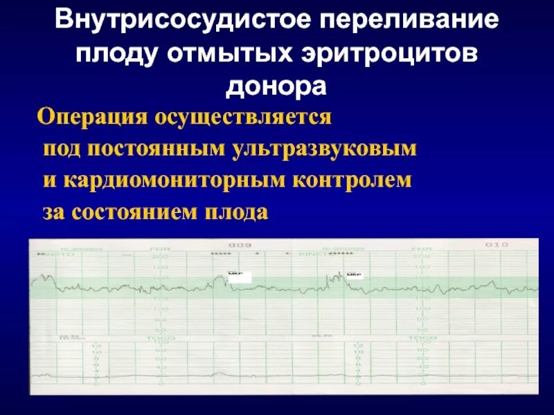 Переливание отмытых эритроцитов. Внутрисосудистой гемотрансфузии плоду. внутриматочная интраваскулярная гемотрансфузия. внутриутробное переливание плоду.