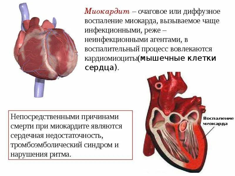 Миокард латынь. Воспаление миокарда миокардит. Миокардит причины возникновения. Инфекционно токсический миокардит.