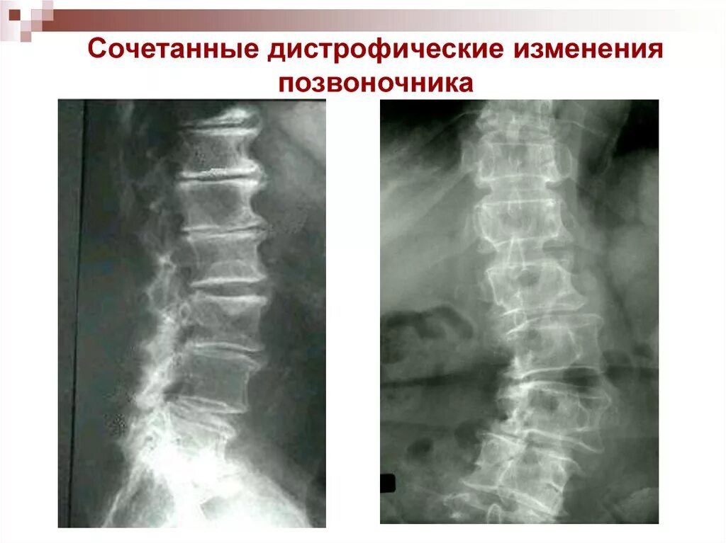 Спондилез шейного отдела рентген. Спондилоартроз грудного отдела на рентгене. Дистрофия дисков грудного отдела позвоночника. Дегенеративно-дистрофические поражения рентген. Дистрофические изменения позвоночника лечение