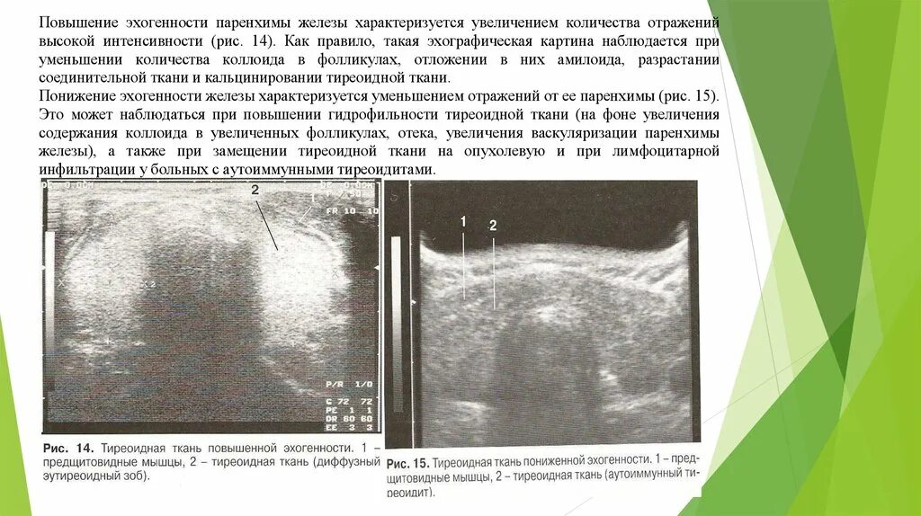 Изменение тканей щитовидной железы. Эхогенность щитовидная железа на УЗИ. Эхогенность снижена УЗИ щитовидная железа. Эхогенность снижена щит железы. Эхогенные структуры на УЗИ щитовидной железы.