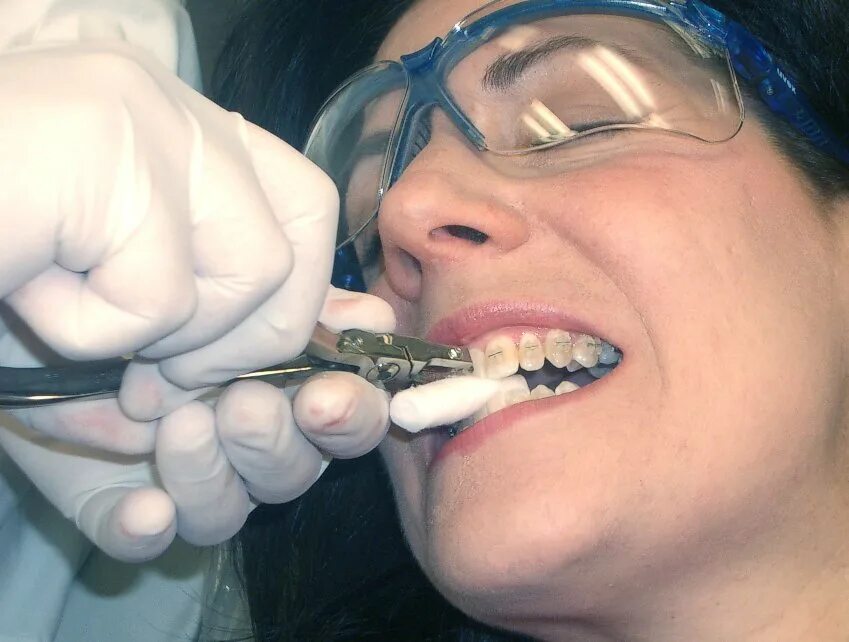Улыбка стоматология. Можно пилить зубы. Подпиливание зубов пилкой для ногтей. Подпиливание переднего зуба. Терапия стоматология.