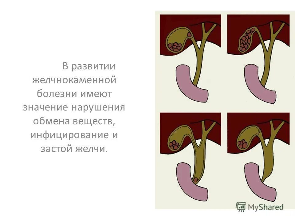 камни желчного протока с холангитом. реактивный панкреатит этиология. гепатит группа заболеваний. профилактика возникновения панкреатита. обследование пациентов с гепатитом.