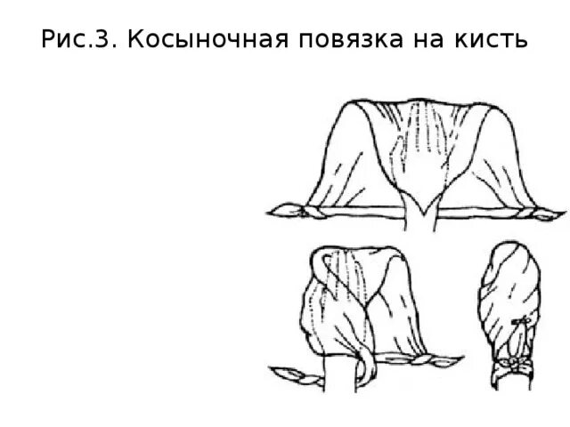 Наложение косыночной повязки на кисть. Наложение косыночной повязки на кисть алгоритм. Наложение косыночной повязки на кисть. Наложение косыночной повязки на кисть алгоритм. Повязка косынка техника наложения.