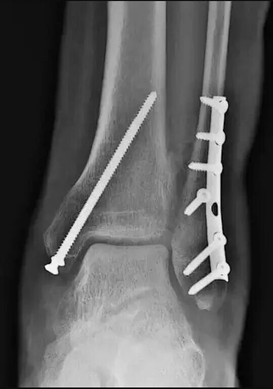 Остеосинтез двухлодыжечный перелом. Перелом лодыжки с остеосинтезом. Остеосинтез межберцового синдесмоза. Остеосинтез наружной лодыжки лодыжки. Остеосинтез операция пластины