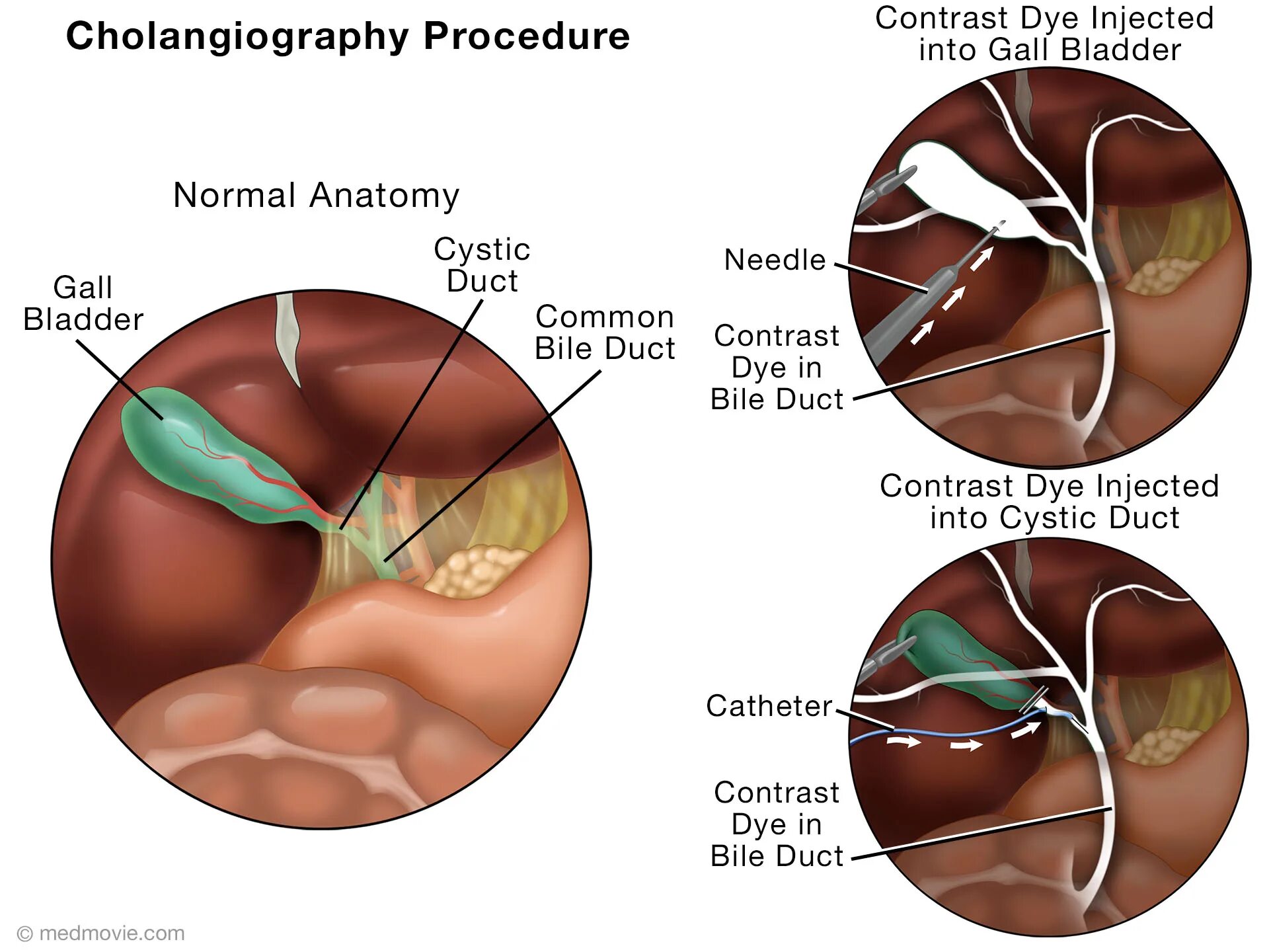 Into procedure