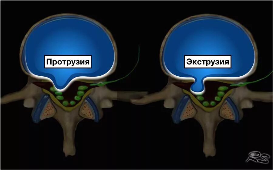Латеральная грыжа диска. Экструзия и протрузия дисков. протрузия и экструзия межпозвонковых дисков. экструзия и протрузия межпозвоночного диска. протрузия экструзия грыжа.