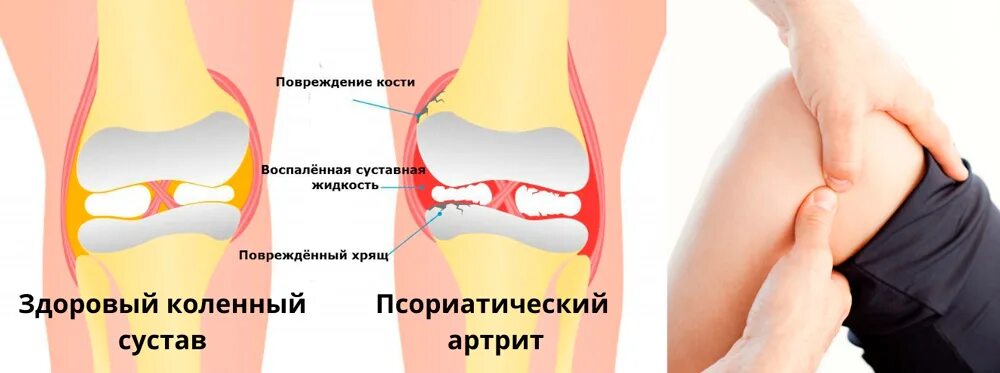 Воспаление коленного сустава что делать Как лечить в домашних условиях lit-dieta