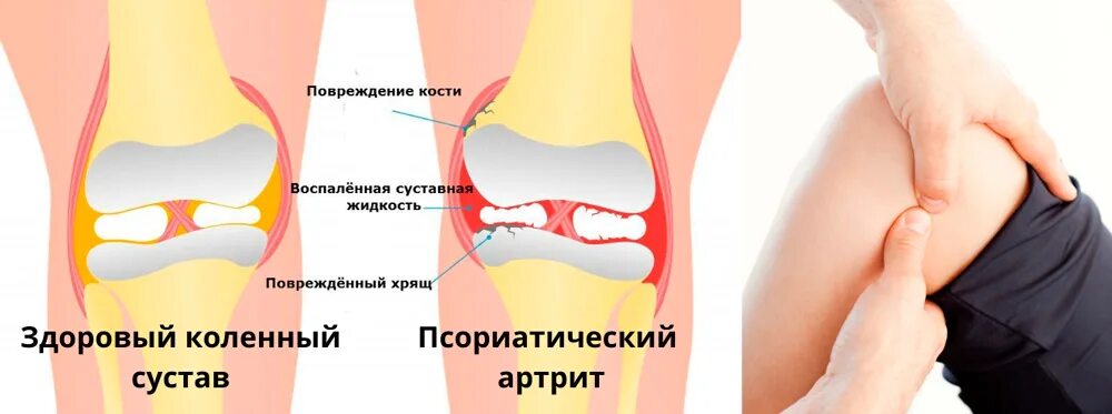 Боли коленного сустава симптомы. Ревматоидный артрит коленного сустава. Псориатический артрит коленного сустава. Артропатия коленных суставов. Псориатический артири.