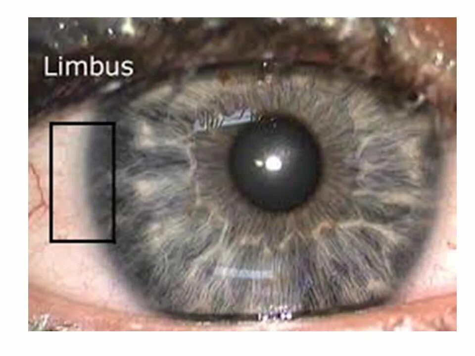 Limbus 3
