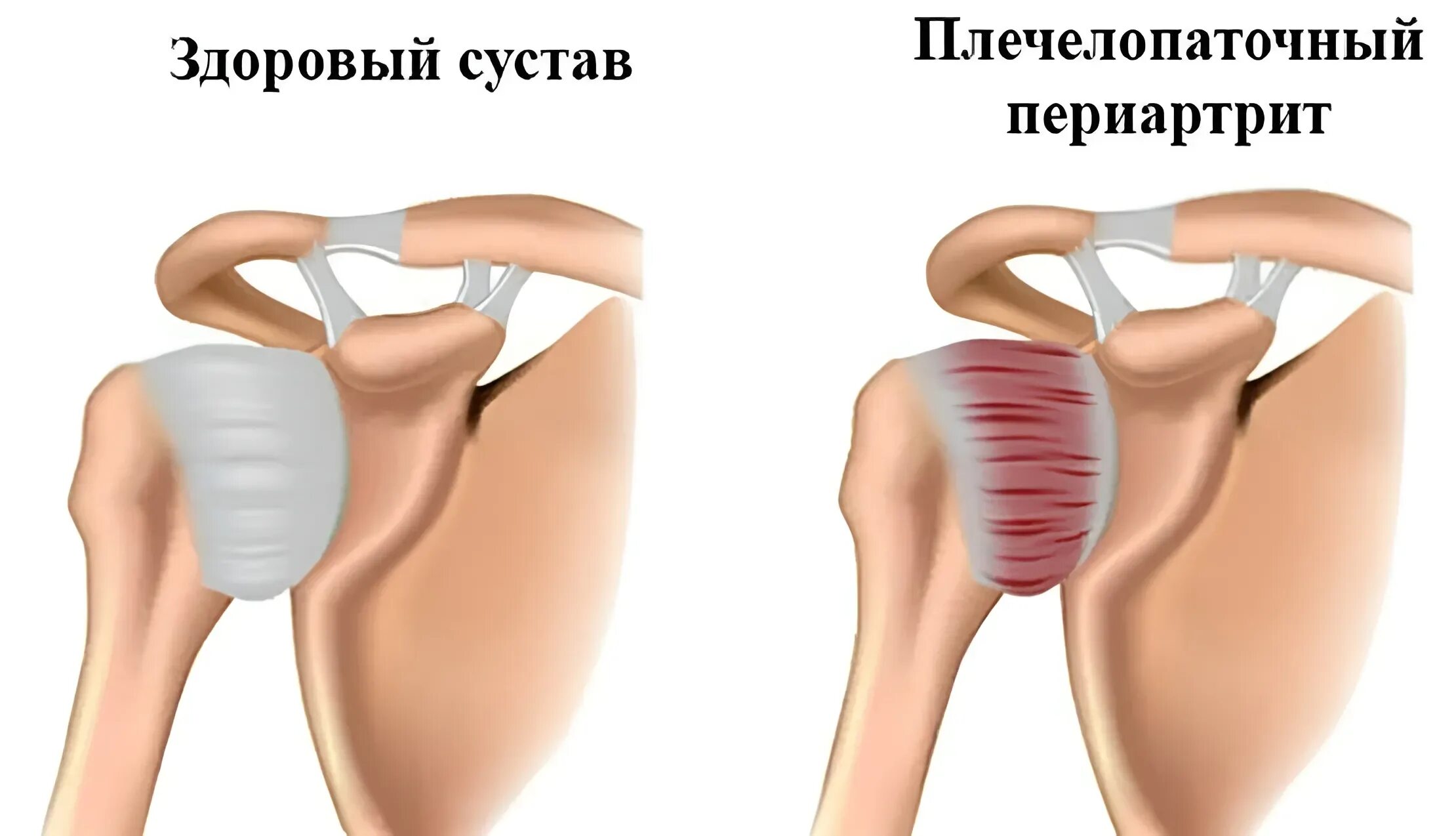 Периартрит плечевого сустава что это такое
