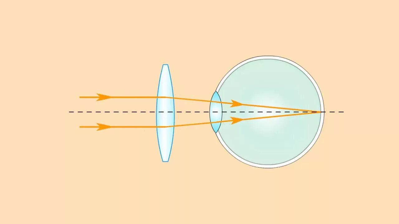 Линзы для дальнозоркости. Дальнозоркость рисунок. Близорукость и дальнозоркость. Дальнозоркий глаз схема.
