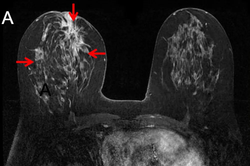 Инфильтративная карцинома. Мрт молочных желез. Опухоль молочной железы мрт. Мрт с контрастом молочной железы.