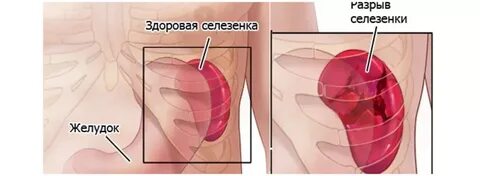 Разрыв селезенки симптомы