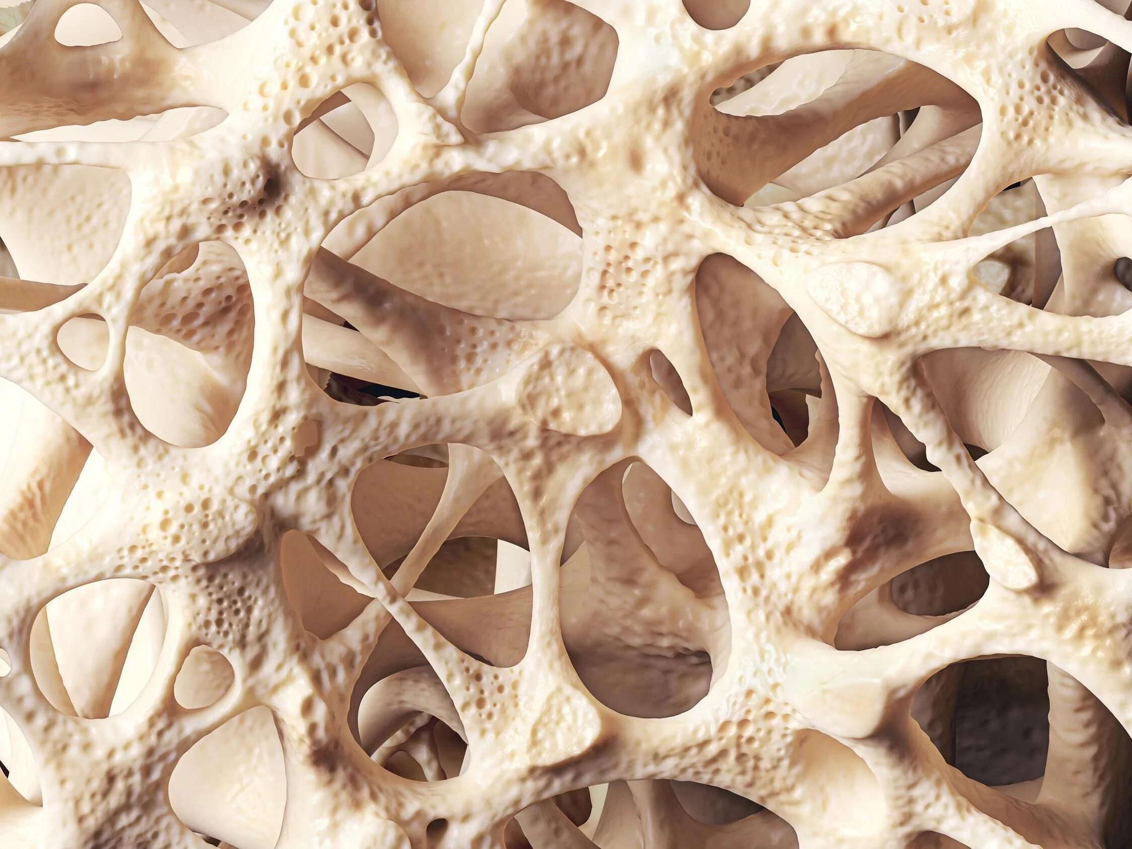 Abnormal Excess Bone Growth in Heterotopic Ossification Stem cell therapy, Osteo