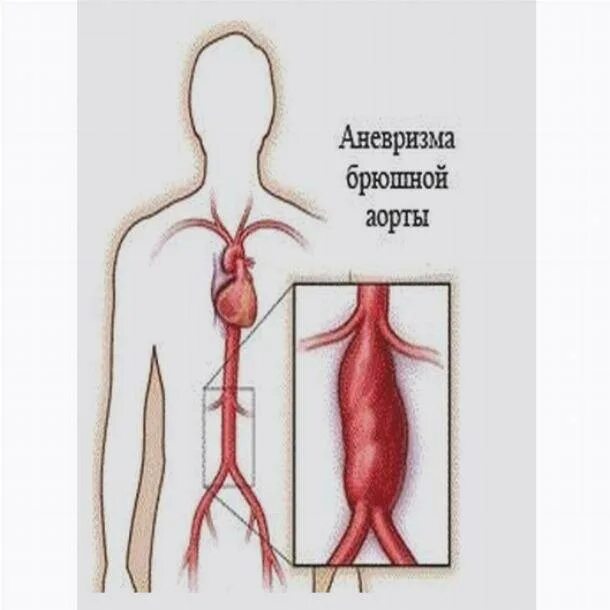 Аневризма аорты после операции. Псевдоаневризма брюшной аорты. аневризма брюшной аорты разрыв клиника. юкстаренальная аневризма. разрыв аневризмы брюшной аорты симптомы.