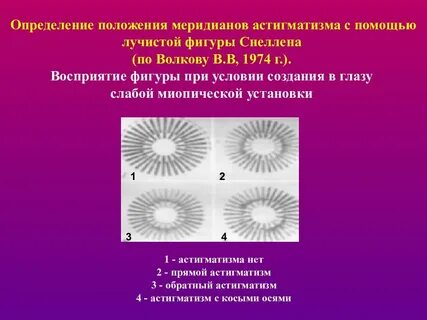 Астигматизм клинические рекомендации
