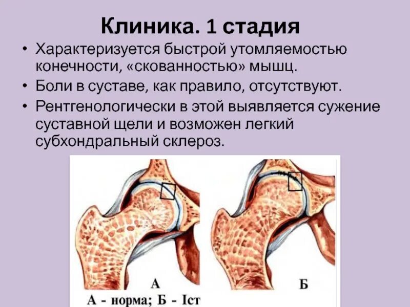 Диагноз доа суставов. Деформирующий остеоартроз клиника. Деформирующий артроз клиника. Деформирующий остеоартрит клиника. Стадии остеоартроза клиника.