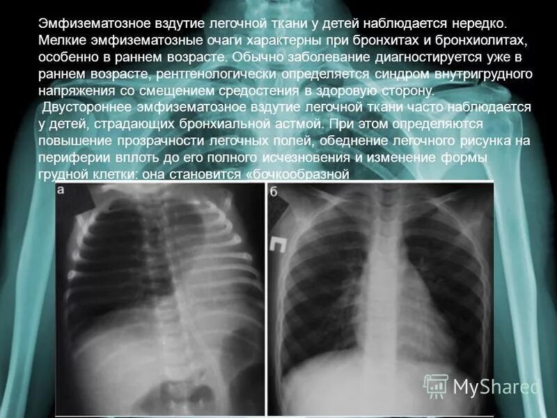 Изменение в легких у ребенка. Лёгкие при бронхите снимок. рентгенодиагностика бронхита. бронхит на рентгене у детей. вздутие легких на рентгене у ребенка.